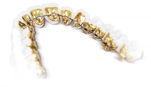 Hidden Lingual Braces: Incognito Treatment Behind Teeth