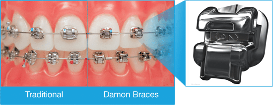 Damon Braces Merrimack and New Boston NH