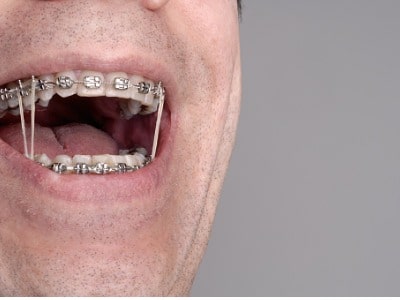 Interarch elastics are important to a successful orthodontic outcome -  Manilla Orthodontics : Manilla Orthodontics